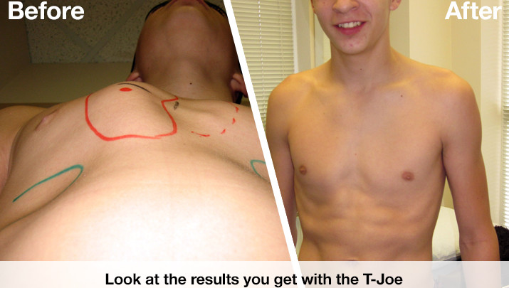 PectusServices's tweet image. Why we're happy to be able to offer you a no-cost, complimentary Pectus Tele-Consultation via Skype!

Schedule your consultation with the creator of the T-Joe Pectus Brace himself: appointment.com/pectusservices