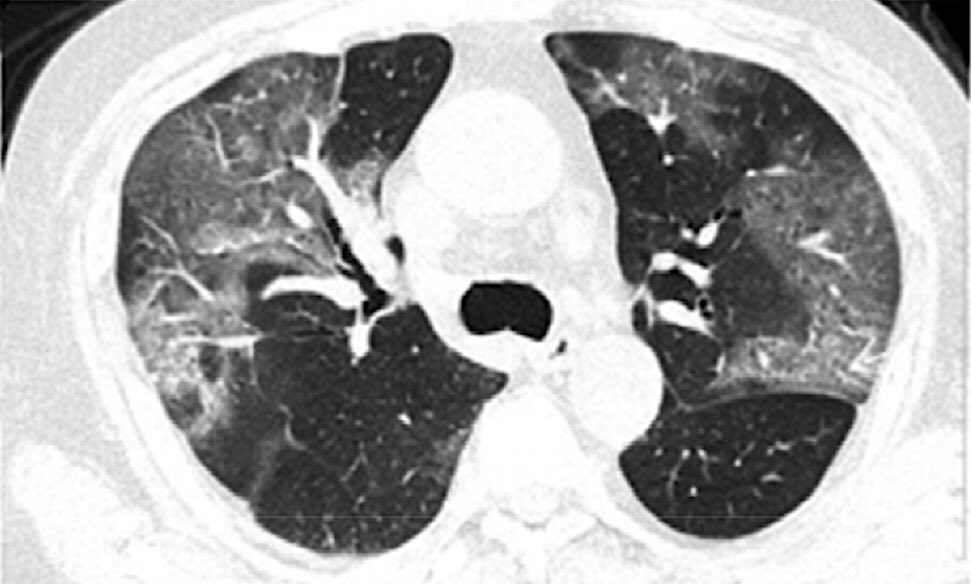  #CT Chest in  #COVID19 Early  #groundglass abnormality in early disease, followed by “crazy paving,” finally increasing consolidationTypically peripheral  #covidclinicalpearls /9