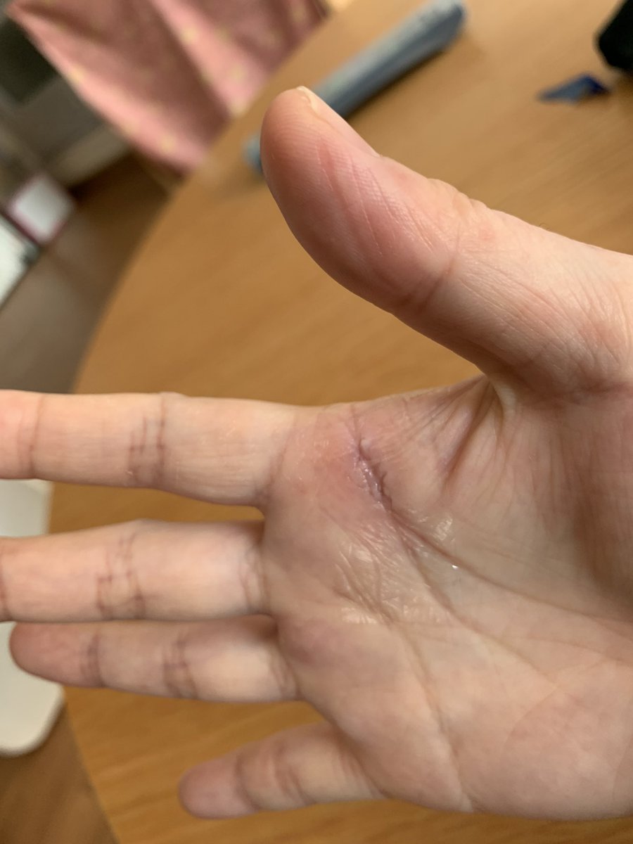 右手 人差し指 痺れ