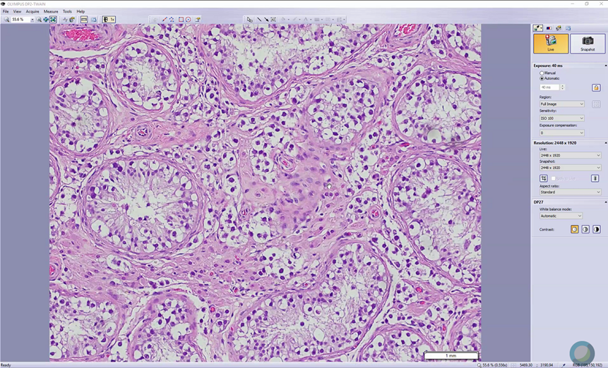 rovingatuscap's tweet photo. Back at it post-Passover, #gupath consensus conference @MSKPathology continues...with a beautiful case of interstitial growth of seminoma #COVID19era #MedEd #testicularcancer @h_alahmadie @BinXu16 https://t.co/tud56aD9lH