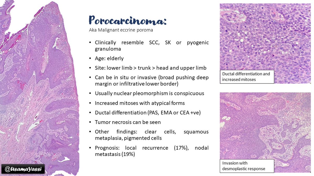 Based on a recent case that I had, porocarcinoma is a rare entity that can be misdiagnosed as SCC. Ductal differentiation was helpful. #dermpath #UTMB #Pathologyflashcards