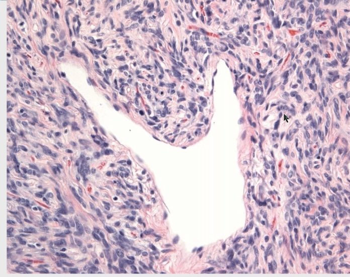 AmritPSinghMD's tweet image. What’s common between Pierre-Marie-Bamberger syndrome and Doege-Potter syndrome? They both are associated with Solitary Fibrous Tumors (SFT) #boardstudy #CAPVirtualPath 🦌