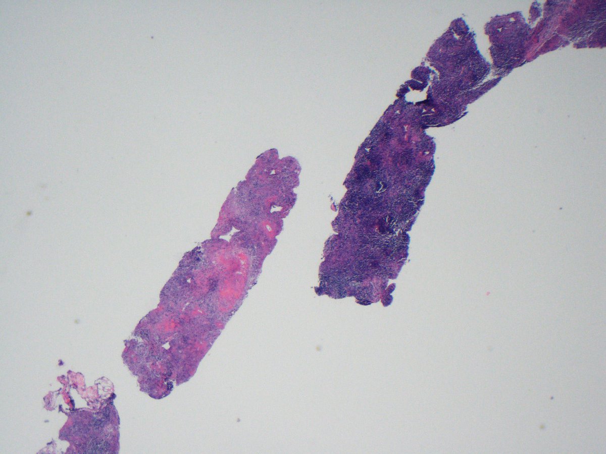 lbsmithmd's tweet photo. Young woman with fever and renal failure. What is your diagnosis? #pathology #hemepath #bestcaseever https://t.co/iYdO0fJsfv