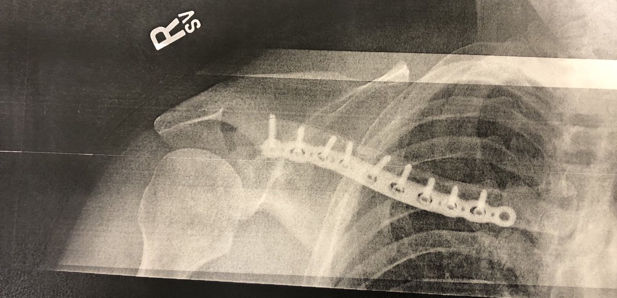 Thanks <a href="/iamspecialized/">Specialized Bicycles</a> for making a great helmet. I crashed mountain biking 2 weeks ago. I broke my collarbone (mesh plate and 9 screws to put it back together) and broke the helmet in four places. I didn’t even realize my head hit the ground!!