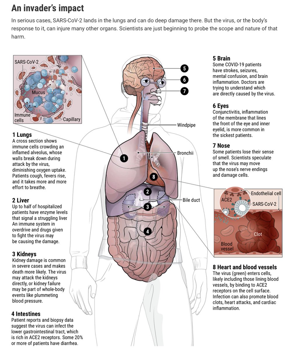 EricTopol's tweet photo. "How does #COVID19 kill? Clinicians trace a ferocious rampage through the body, from brain to toes"
https://t.co/3lnB7AfwIK via @sciencecohen by @meredithwadman @cmatacic @jocelynkaiser 
@ScienceMagazine @NewsfromScience w/ @ScienceVisuals @oooitsplasma https://t.co/epgusdE3lT