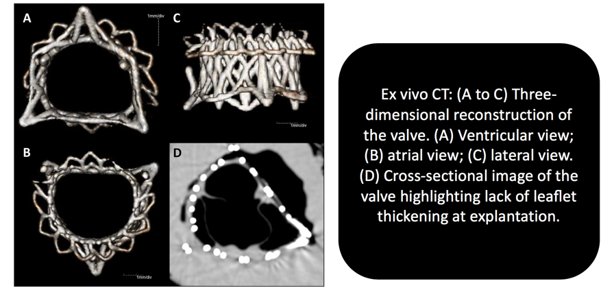 JACCJournals's tweet photo. New in #JACCaseReports: Experts from @HLIStPauls in Canada present the first pathological analysis of the novel and unique Tiara transcatheter mitral valve, which provided a two-year bridge prior to transplant. https://t.co/CpJ1r9DpCc #VHD #LVAD https://t.co/4ltkbfllpU