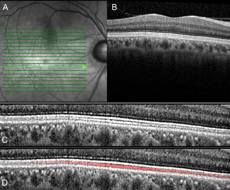 ARVOiovs's tweet photo. New @ARVOiovs: "#Interdigitation Zone Change According to #Glaucoma-Stage Advancement."
Findings suggest, tentatively, that changes in the outer retinal layer can occur in #glaucoma progression.
Read the full article for free: https://t.co/5m4YgNA4dh @SNUnow #OCT #retina https://t.co/n75mIdvHRA