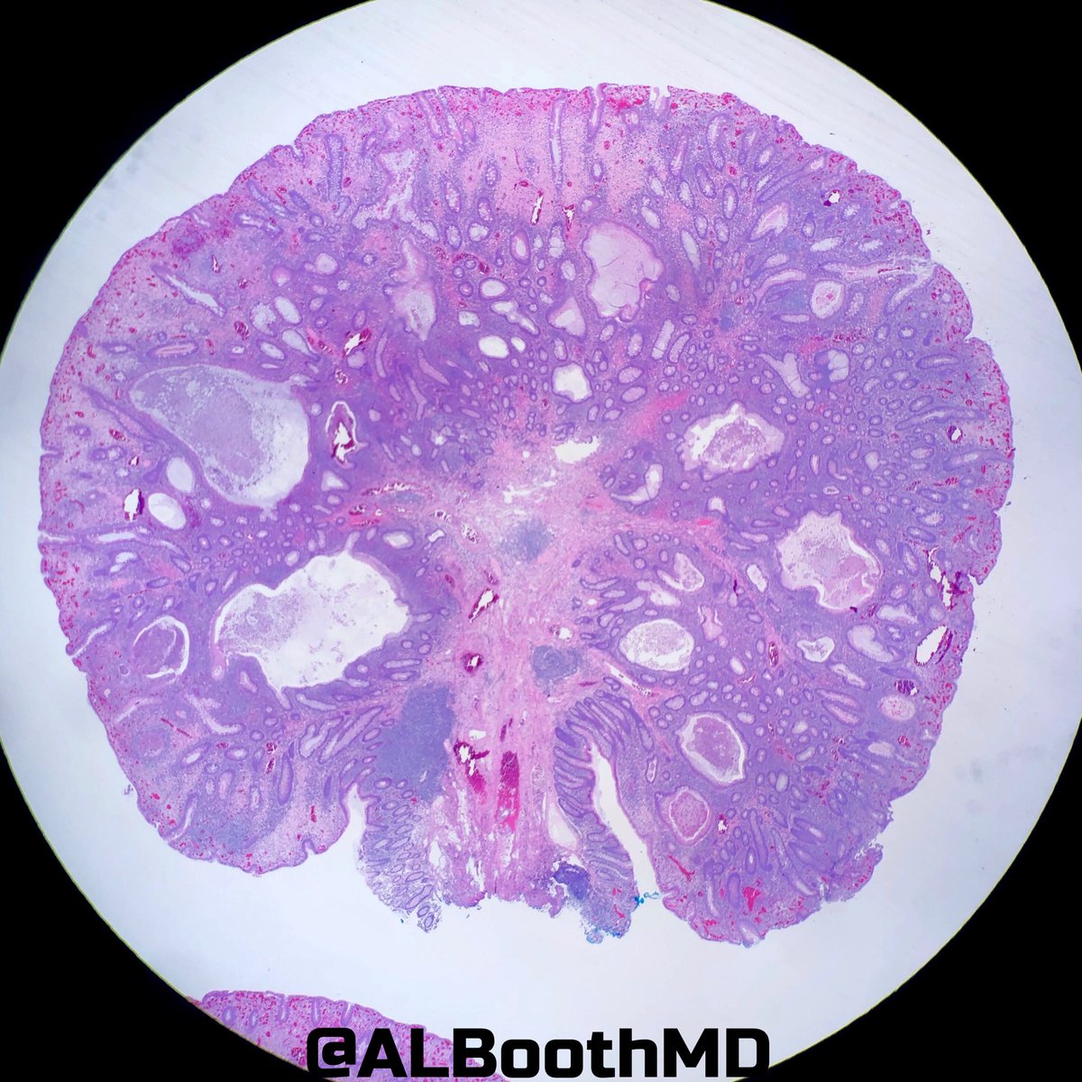ALBoothMD's tweet photo. Did you watch #CAPVirtualPath yesterday? What would you call this 1 cm polyp in the cecum? #gipath #gastroenterology https://t.co/Rv2Vtvm5jh