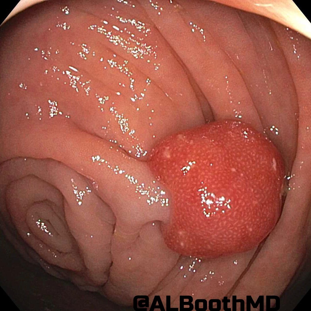 ALBoothMD's tweet photo. Did you watch #CAPVirtualPath yesterday? What would you call this 1 cm polyp in the cecum? #gipath #gastroenterology https://t.co/Rv2Vtvm5jh