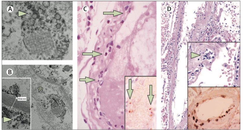 iamritu's tweet image. #COVID19 viral bodies found within endothelial cells with accumulation of inflammatory cells &amp;amp; endothelial/ inflammatory cell death 
#COVID19 endotheliitis➡️ systemic impaired microcirculatory function in different vascular beds &amp;amp; their clinical sequelae
bit.ly/3ct3zIJ