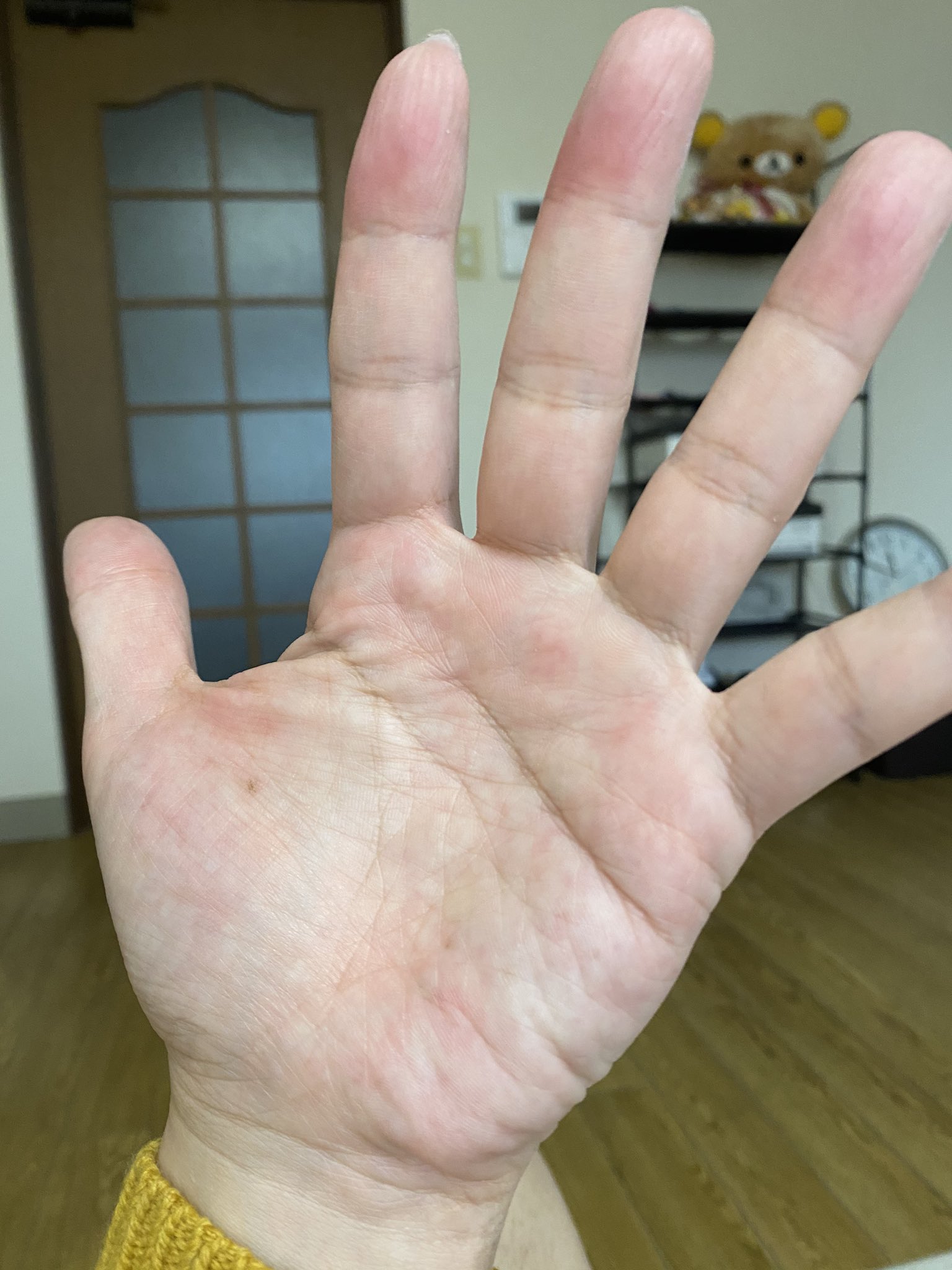 手荒れひどい Twitter Search Twitter