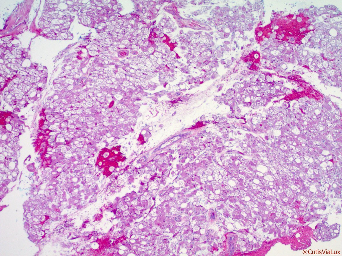 CutisViaLux's tweet photo. A #hibernoma for our Covid hibernation. 3 types of cells - adipocytes, vacillated adipocytes, and eosinophilic cells. A granular cell tumor doesn't have vaculated adipocytes so its easy to tell them apart! #Pathology #Dermpath #Derm https://t.co/Na6cX4negy