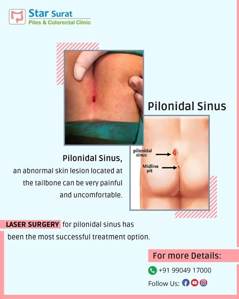 starsuratclinic's tweet image. 👉Pilonidal Sinus an abnormal skin lesion located at the tailbone can be very painful and uncomfortable.

👨‍⚕️Laser Surgery for pilonidal sinus has been the most successful treatment option.
📞Consult us: +919904917000

#pilonidalsurgery #PilonidalSinus #lasersurgery