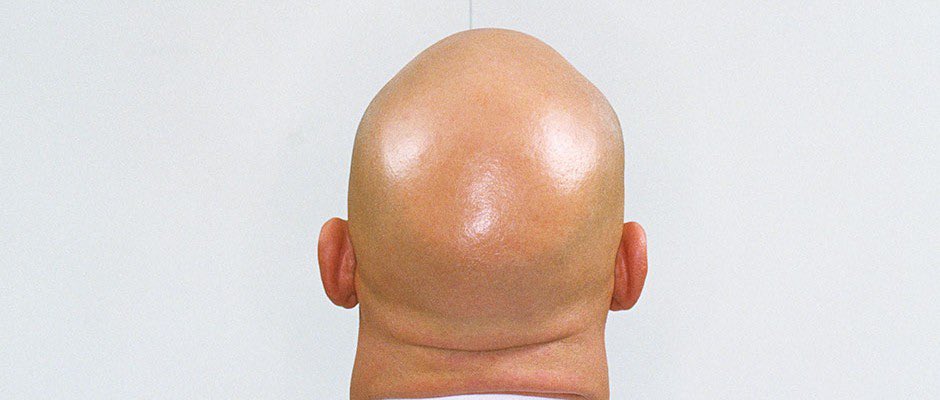 AlpecinJohn123's tweet photo. Twitter needs to know about the idiots at @Headshoulders 😡 on the left is my head after using them for 24 years and on the right is my head after using @AlpecinDE for 2 years. I WILL BE SUING HEAD AND SHOULDERS PLEASE RETWEET https://t.co/MjK0iWsmiB