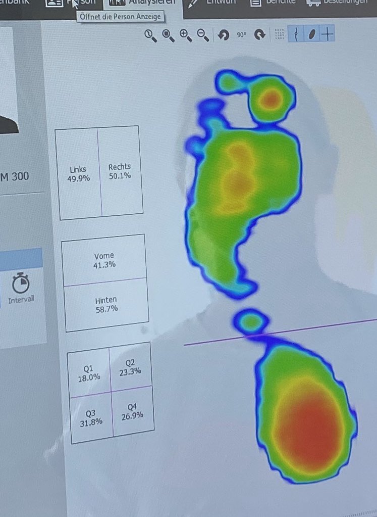 MySportsPhysio's tweet photo. Promising first attempts: Static limb asymmetry after prox hams pain improved after visual training (running 3 min with a prisma). Still a lot of work to get ahead but great to learn from the best @sehzentrumzueri Great collaboration #therapiekreuzplatz #numosystem https://t.co/wbLvP7thXF