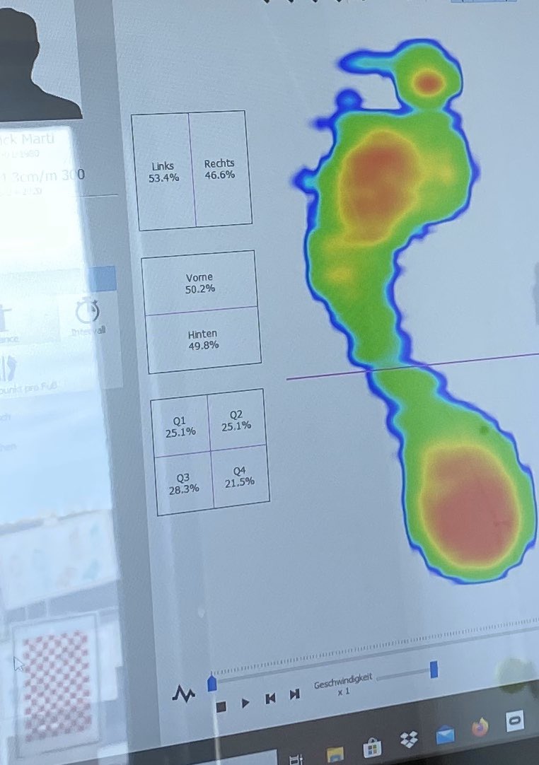 MySportsPhysio's tweet photo. Promising first attempts: Static limb asymmetry after prox hams pain improved after visual training (running 3 min with a prisma). Still a lot of work to get ahead but great to learn from the best @sehzentrumzueri Great collaboration #therapiekreuzplatz #numosystem https://t.co/wbLvP7thXF
