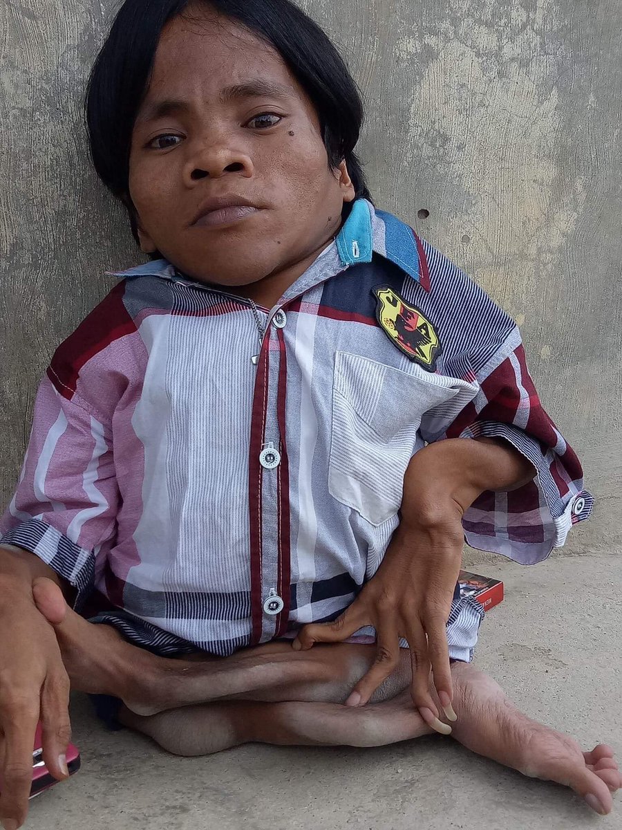 Horas.... Perkenalkan namaku Roy Marguna Manalu. Kek ginilah aku sejak lahir. Aku mengalami lumpuh layu yang membuatku tak bisa berjalan seperti orang normal. Ya Sudah 32 tahun aku menjalani hari2 ku seperti ini. Meskipun demikian aku tidak putus asa dan selalu semangat.