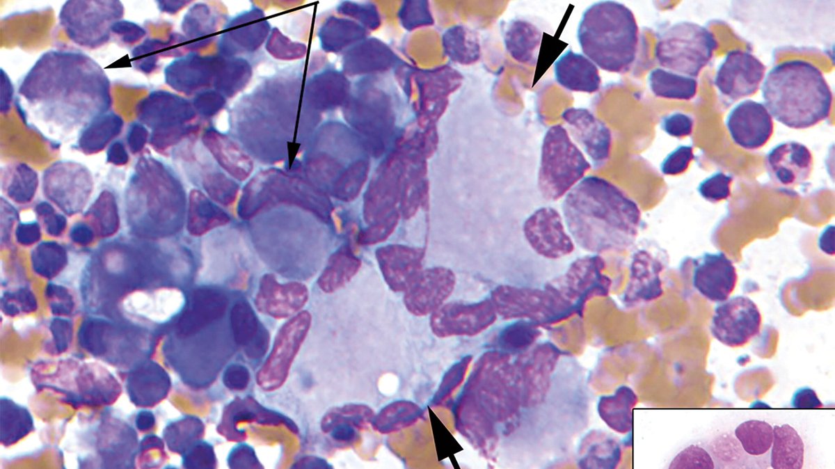 Pathologists's tweet photo. Pathologic Features of Down Syndrome Myelodysplastic Syndrome and Acute Myeloid Leukemia: A Report From the Children's Oncology Group Protocol AAML0431; read in the current @ArchivesPath: https://t.co/xLnT0bWYdK. #pathologists https://t.co/hbV7oBRxjz