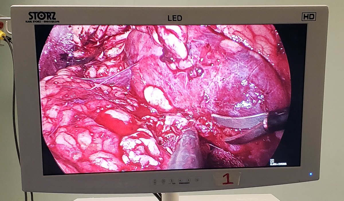 DrRodriguezUro's tweet photo. Tumorectomia lumboscopica por Tumor Renal Derecho.

#laparoscopy #urology #urologia #monterrey https://t.co/iLKSbzj8Sp