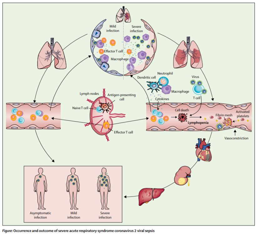 TheLancet's tweet photo. NEW Hypothesis—H Li, L Liu, D Zhang et al hypothesise that a process called viral sepsis is crucial to disease mechanism of #COVID19 "Although these ideas might be proven imperfect or even wrong later, we believe they raise questions for future research" https://t.co/0rTv81ocO0 https://t.co/VP2GMvGFOf