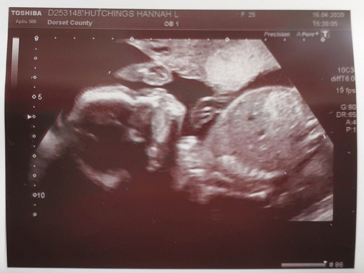 We had our scan pictures in the post today as they got forgotten at my scan on Thursday and the staff went above and beyond. Sent us 12 different pictures all free of charge 😍 Nice to have them as Joe wasn't allowed in the scan.