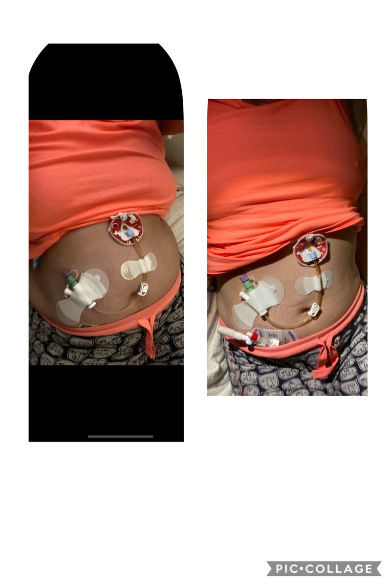 baskett_case's tweet photo. The life of a #tubie #tubefeeding #pegj #Gastroparesis #malabsorption severe bloat from feed and part paralysed Bowel and bladder - bloated one taken 45 minutes before Bowel irrigation and medications looks like a different person crazy how anatomy can change in 45 mins! https://t.co/ptupHNVGap