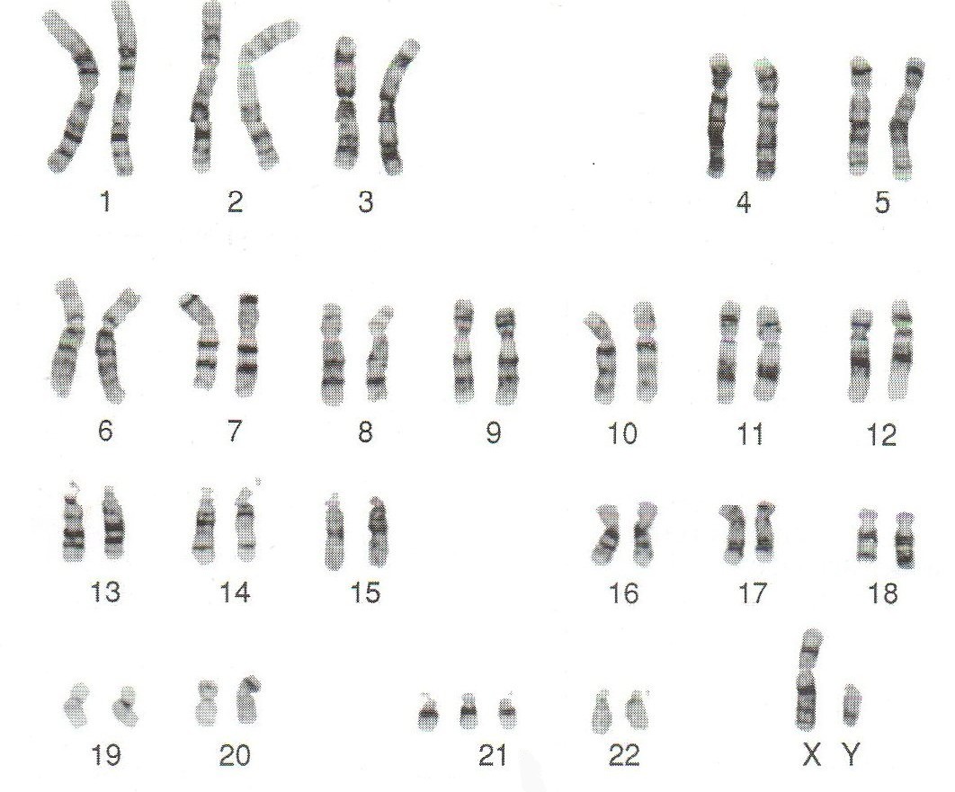 50 chromosome. Синдром Дауна трисомия 21 хромосомы. Трисомия 21 хромосомы (синдром Дауна кариотип. Синдром Дауна трисомия 21. Синдром Дауна трисомия кариотип.