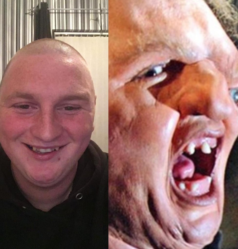 When BOTOX goes wrong 🙈