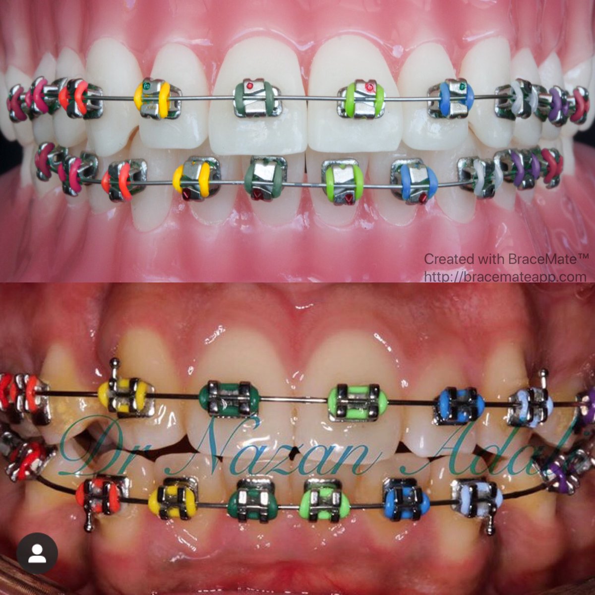 Check out the rainbow braces by Nazan Orthodontics l 
#braces #orthodontics #orthodontist #americanorthodontics #braceson #braceslife #colour #colours #london #specialistorthodontist #ortho