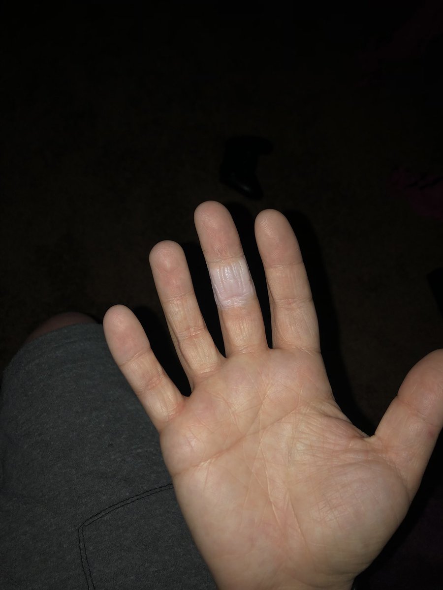 madsxleviosaaa's tweet photo. i have cuts all over my hands cause of the spray we use at work. i put a band aid on cuz sanitizer burnt my cut. look at that difference 🤣 #imtired #undertstand #dontbeadickhead https://t.co/6QvwvCWXzm