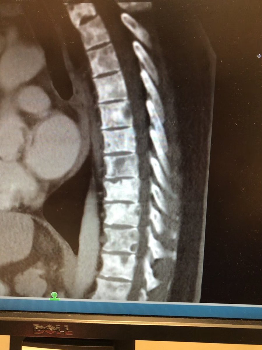 vtrock15's tweet photo. @PalmBeachBelle @scheana This makes me absolutely sick! I am really battling stage 4 invasive ductal carcinoma breast cancer that has mets to my bones! Mainly my spine! Here is my proof! It sickens me that anyone would lie! I wish I could get help handed to me! https://t.co/m2igxrtlE4