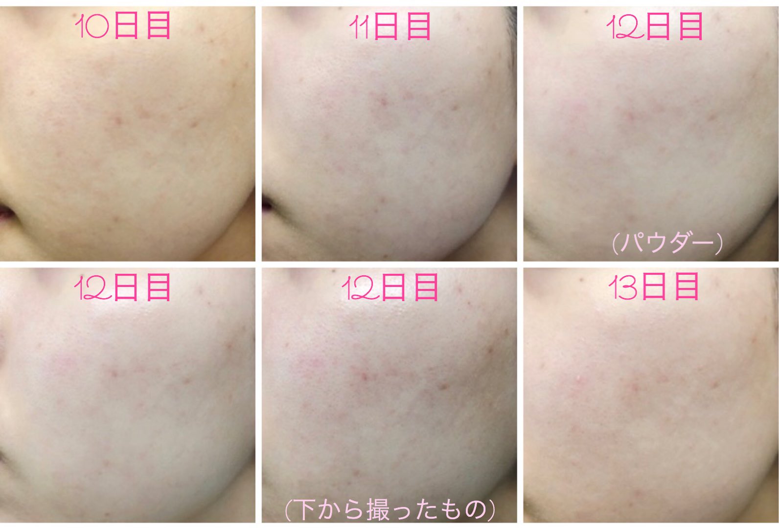 まひろちゃん 30日目 暑くなってきたのでスキンケアはイハダの化粧水のみに変更 バームは使わず 31日目 毛穴やば 33日目 毛穴が目立たなくなってきた 生理前で相変わらず顎の治安は悪いものの 徐々に毛穴が目立ちにくくなってきたような気