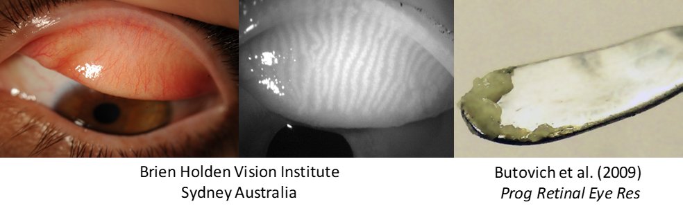 The lipid layer of the tear film is supplied by gland known as meibomian glands, which secrete a waxy substance known as meibum. The lipids produced by these glands are quite unusual and have captured the interest of a number of researchers over the years.