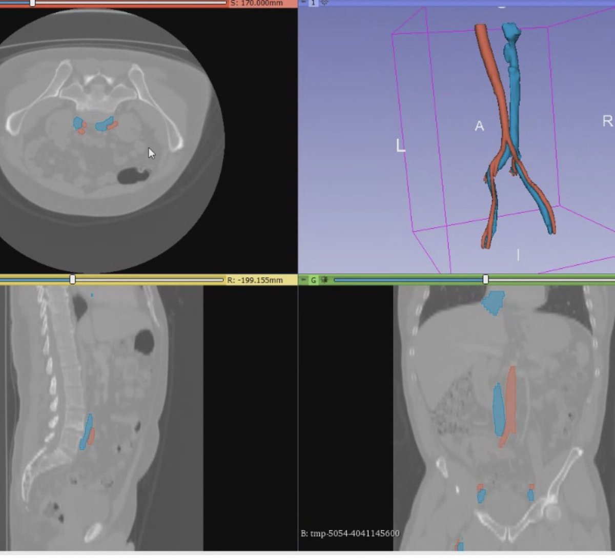 siemionowkris's tweet photo. #MachineLearning #vessle segmentation. Fully autonomous solution that will allow spine surgeons to avoid vascular injury. @HoloSurgical https://t.co/8StISM4LyK