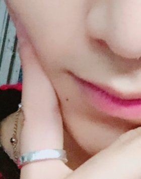 his chin mole (? which appeared once and disappeared forever