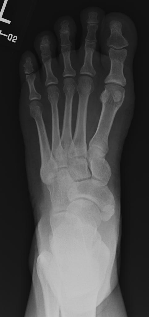 Accessory navicular is a normal variant seen in up to 12% of the ...