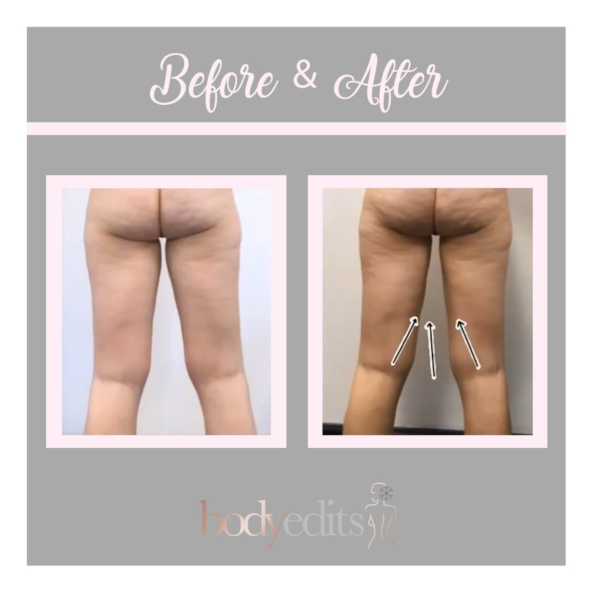 Sadaf_Jaffari's tweet photo. Check out these amazing results after a patient at @dermaspa_mk
had CoolSculpting® to reduce the fat on the thighs. https://t.co/HURyaCfDuf