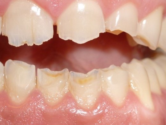 bpdentist's tweet photo. @Cosmetexpert @CitronAlcalin Une belle catastrophe pour la santé dentaire, l'aliment le plus acide. Augmentation du nombre de patients ravagés par ces pseudos conseils "bien être". Et cela un vrai retentissement negatif sur leur santé a long terme @UFSBD.
Plus le pseudo dentifrice solide ou maison #DIY 😱☠️ https://t.co/G1o5Xr6YRn