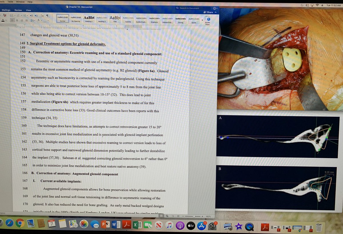 JaredMahylisMD's tweet photo. #COVID19 #SocialDistanacing productivity during little one’s scheduled naptime. Finishing up book chapter -Treatment of asymmetric glenohumeral OA. #shouldersurgery #totalshoulder. https://t.co/NbNDkGrVOM