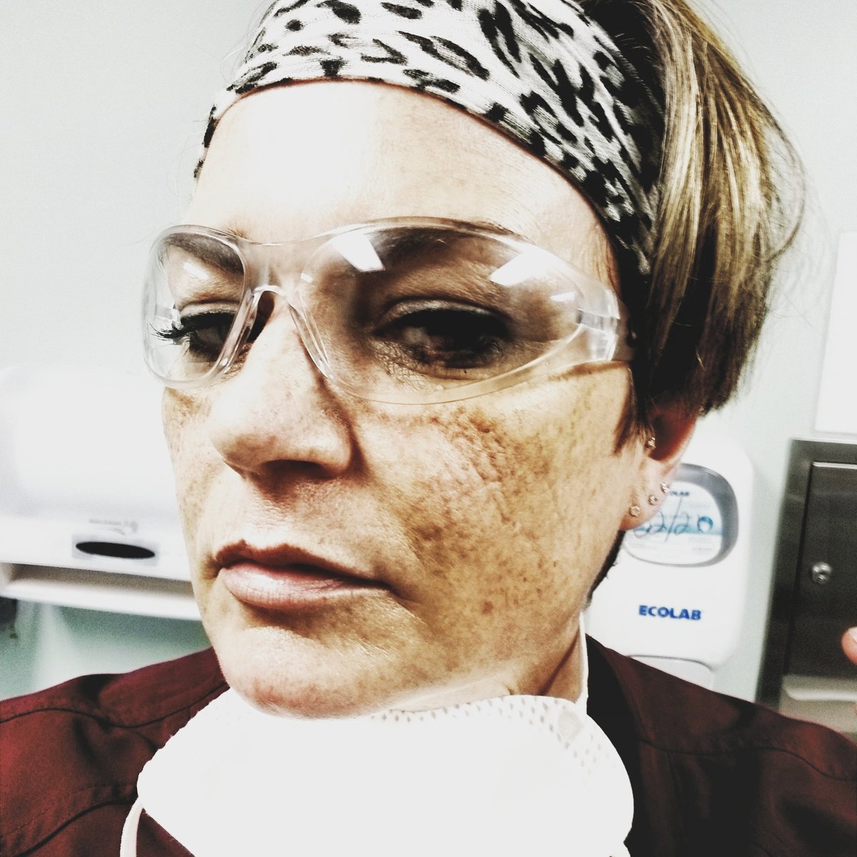 This is what N95 masks does to your face and this one was donated. I'm furloughed and if I see  #FilmYourHospital one more fucking time... its over for you cunts.