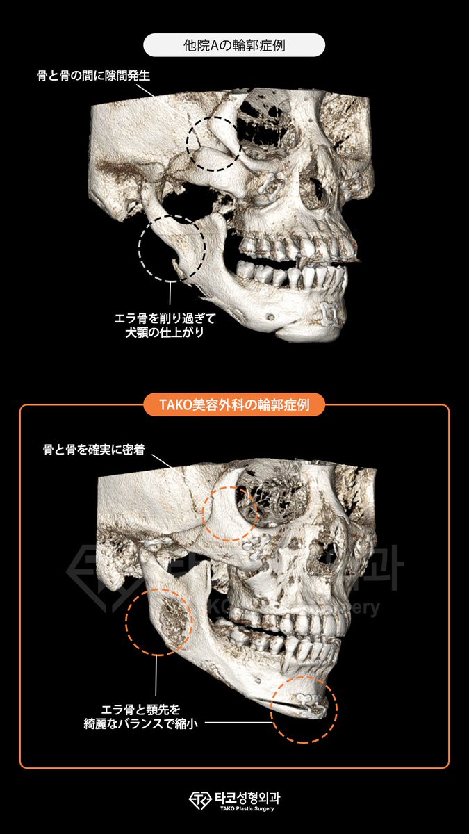 Tako美容外科 Twitter પર 輪郭整形は目には見えない骨を触る手術なので 手術前後のct撮影が最も大事です Tako美容外科は手術前から術後の経過まで精密3d Ctでしっかり検査して 輪郭手術であり得る 後遺症や合併症を予防します Tako美容外科 キムタクホ 輪郭 V