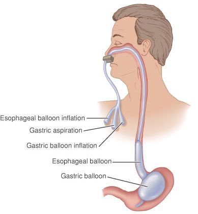 fahedjulien's tweet photo. #COVID19 #GI #urgentcasesonly #bleedingvarices Blakemore tube is one of those things that you think that you’ll never need until you do.. https://t.co/6bE4laLWQw