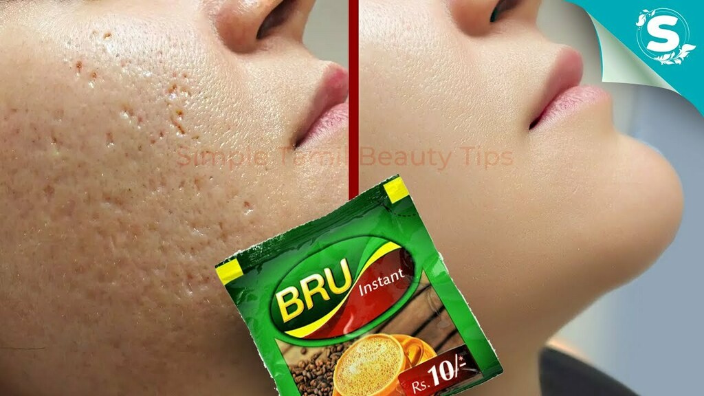 pimple clear tips in tamil
