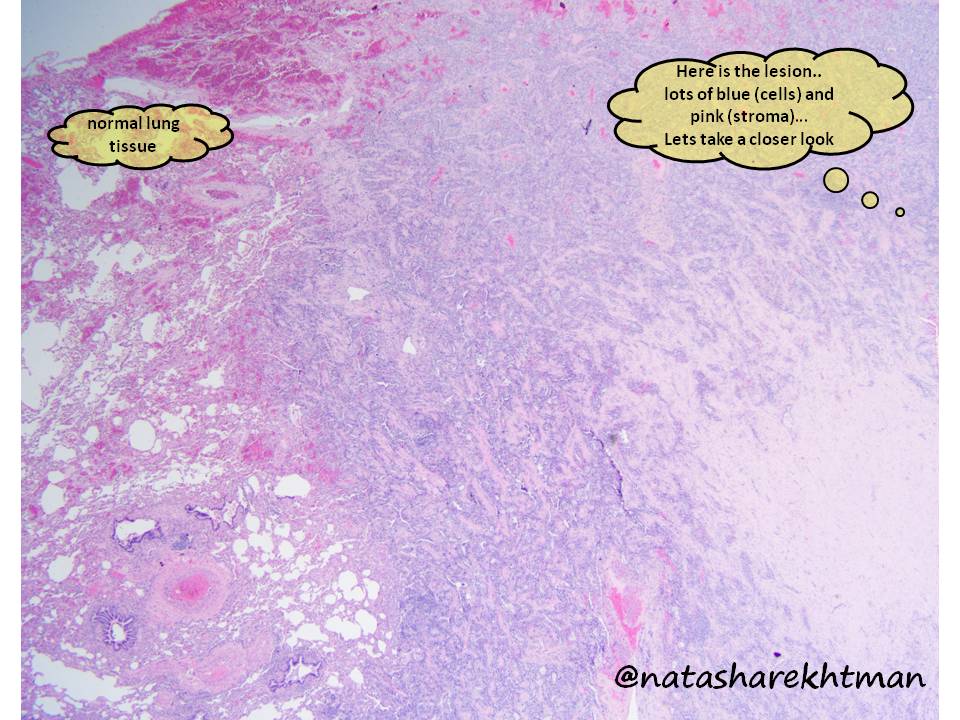 With so much disruption with education, and much need for a distraction… seems like a perfect time for  #natpathpuzzler. 3 cm lung nodule in a 40 yo woman. For this one, I included my thoughts as I was first looking at this case (some helpful.. some not).  #pulmpath  @PulmPathSoc