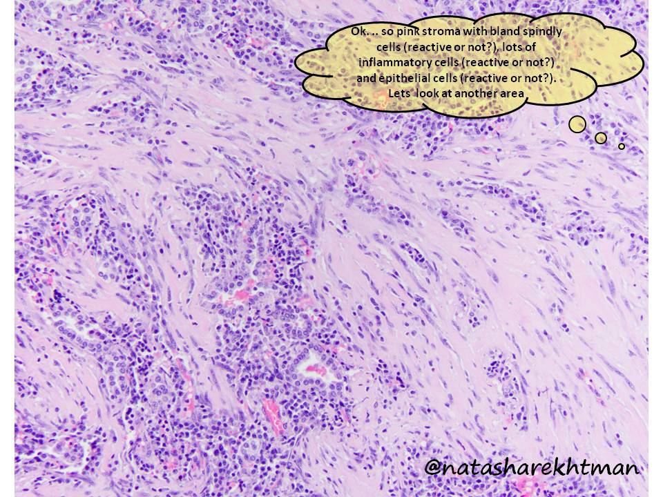 With so much disruption with education, and much need for a distraction… seems like a perfect time for  #natpathpuzzler. 3 cm lung nodule in a 40 yo woman. For this one, I included my thoughts as I was first looking at this case (some helpful.. some not).  #pulmpath  @PulmPathSoc