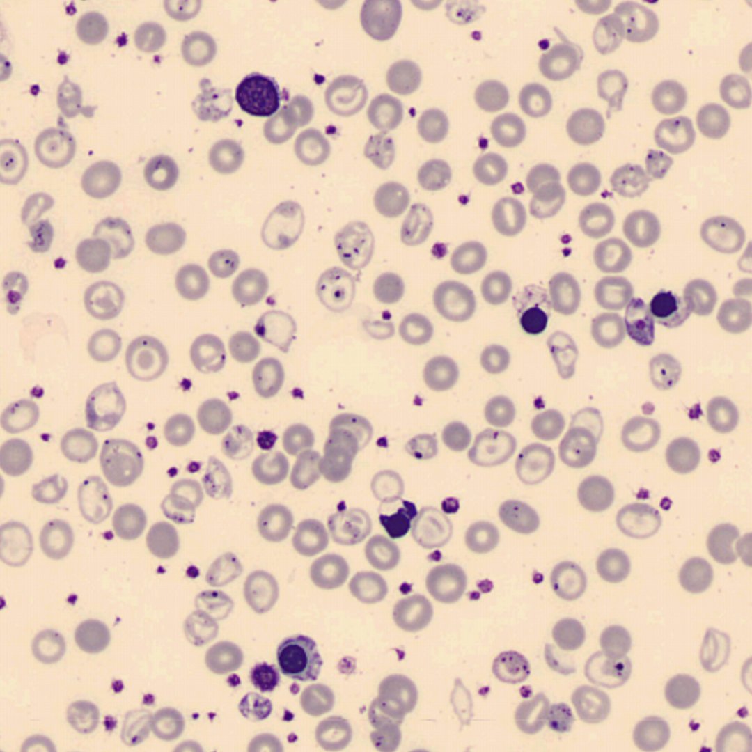 What about this #redbloodcells #morphology?
#peripheralbloodsmear
#citology