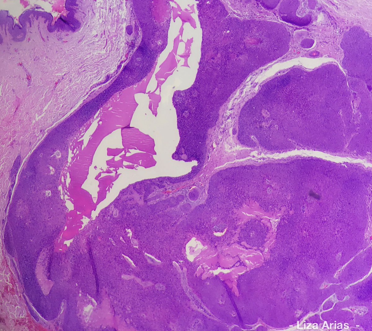 LizaAriasT's tweet photo. #Hidradenoma #SolidCysticHidradenoma #Hidroadenoma #DraLizaArias #Dermpath #LovingDermPath #Dermatopathologist #Dermatopathology #Dermatology #Dermatologist https://t.co/fXgLXIz9qa