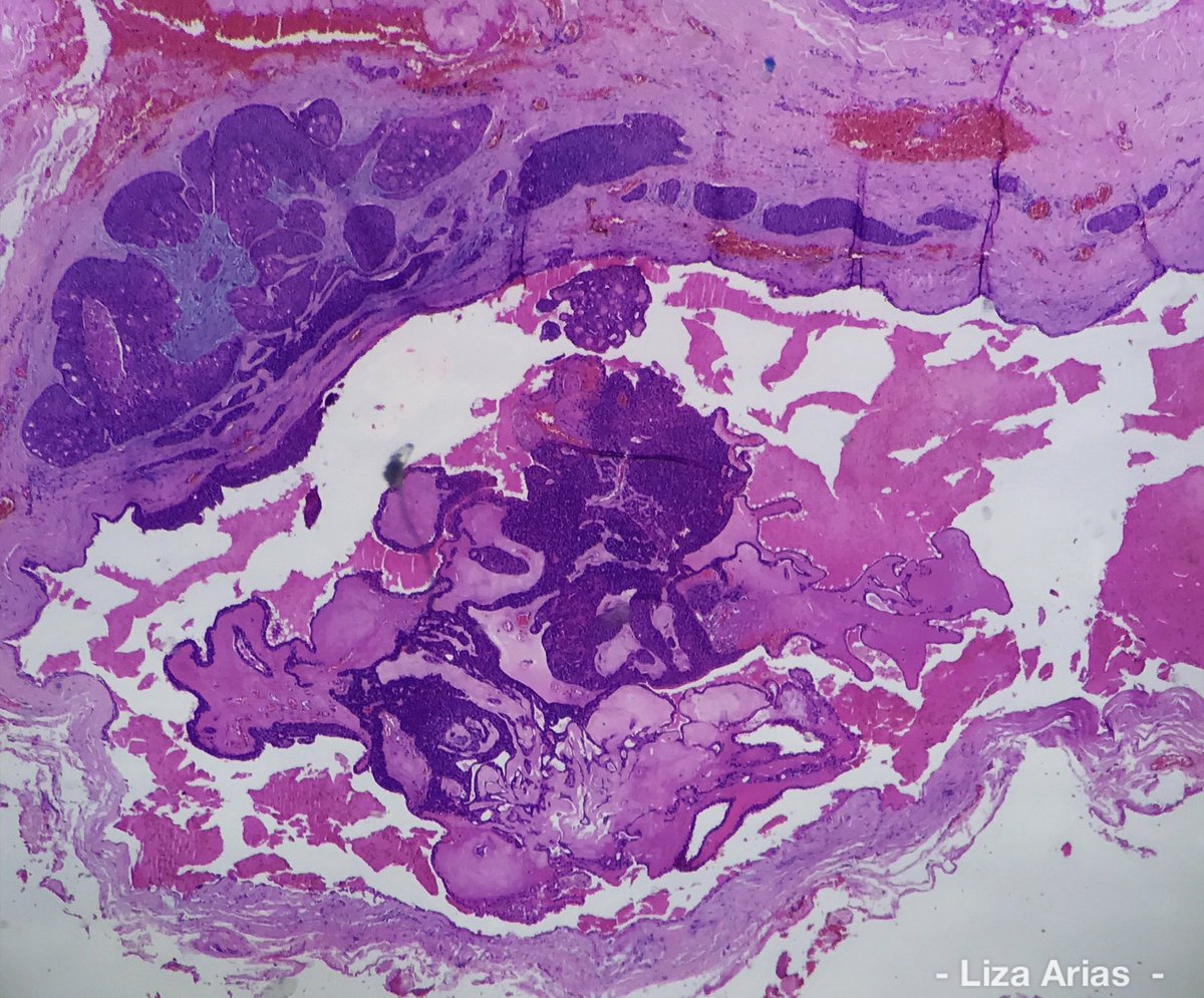 LizaAriasT's tweet photo. #Hidradenoma #SolidCysticHidradenoma #Hidroadenoma #DraLizaArias #Dermpath #LovingDermPath #Dermatopathologist #Dermatopathology #Dermatology #Dermatologist https://t.co/fXgLXIz9qa