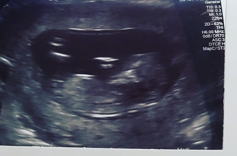 JHFgaming's tweet photo. Had to miss the scan because of hospital visitor restrictions so absolutely gutted but now we know all is well I can announce. I'm going to be a father again 😮❤️😊

#Suprised https://t.co/F5aHb2MhUN
