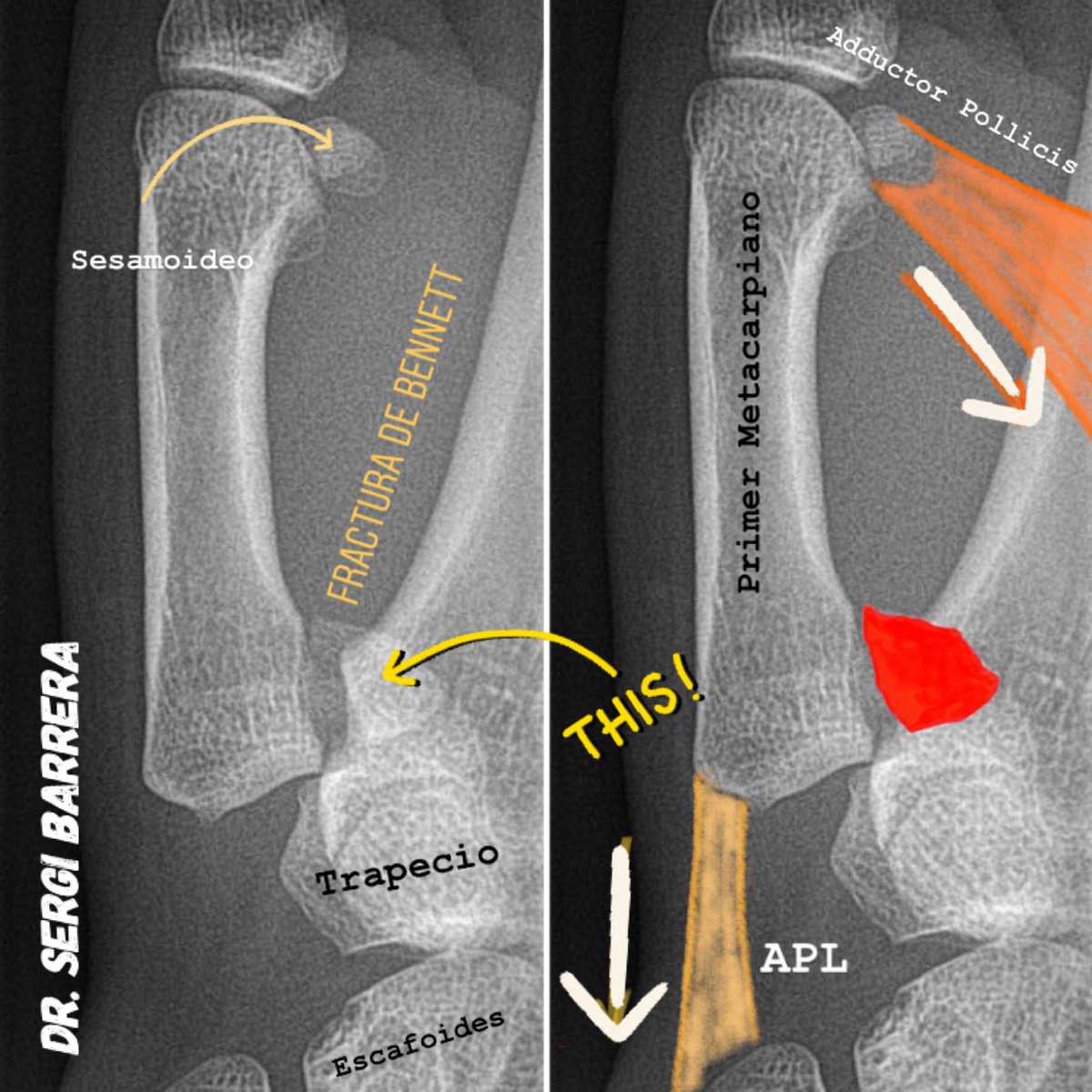 DrBarreraochoa's tweet photo. Fractura de Bennett
▪️Edward Hallaran Bennett, profesor de cirugía la describió en 1882
▪️Fx intrarticular de la base del 1er MTC
▪️Fx muy frecuente entre las fracturas del pulgar
▪️La deformidad resultante es por efecto del APL y el Adductor Pollicis https://t.co/cc45Pv8AW4